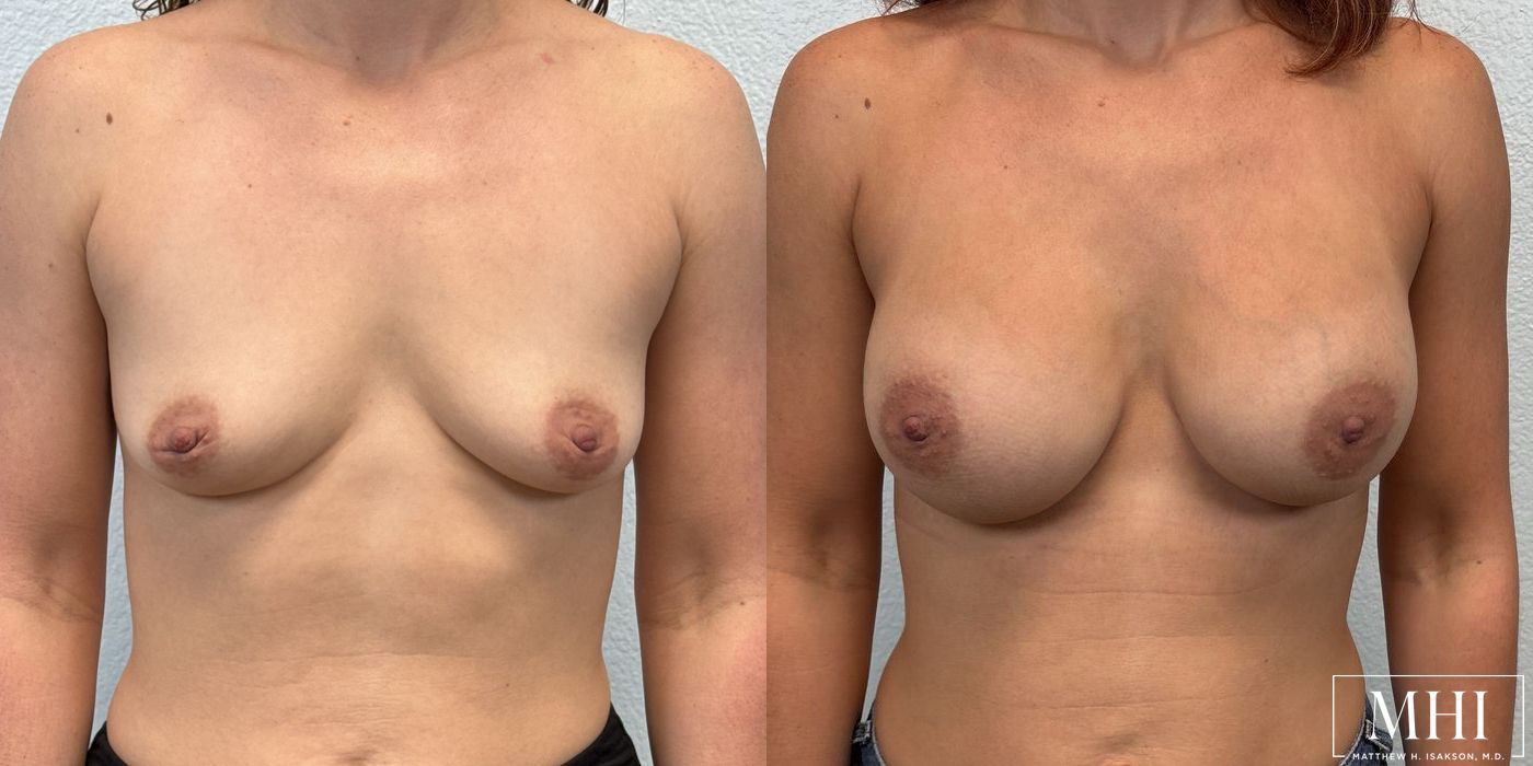 Breast Augmentation - Case 12115