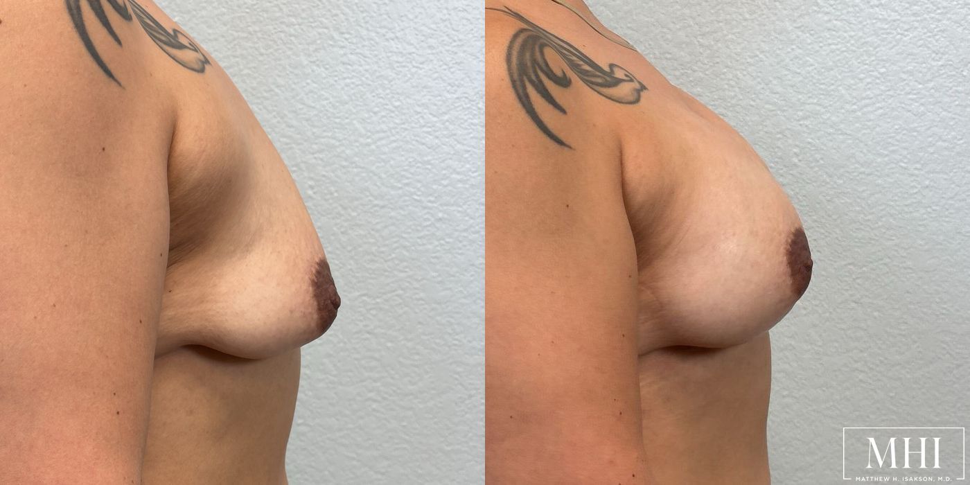 Breast Augmentation - Thumbnail 5