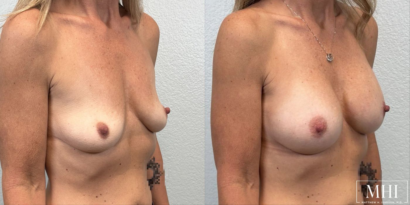 Breast Augmentation - Thumbnail 4