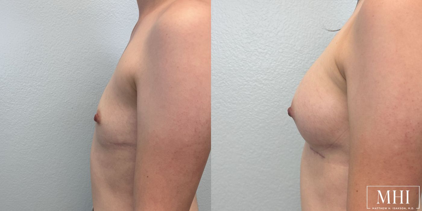 Breast Augmentation - Thumbnail 3