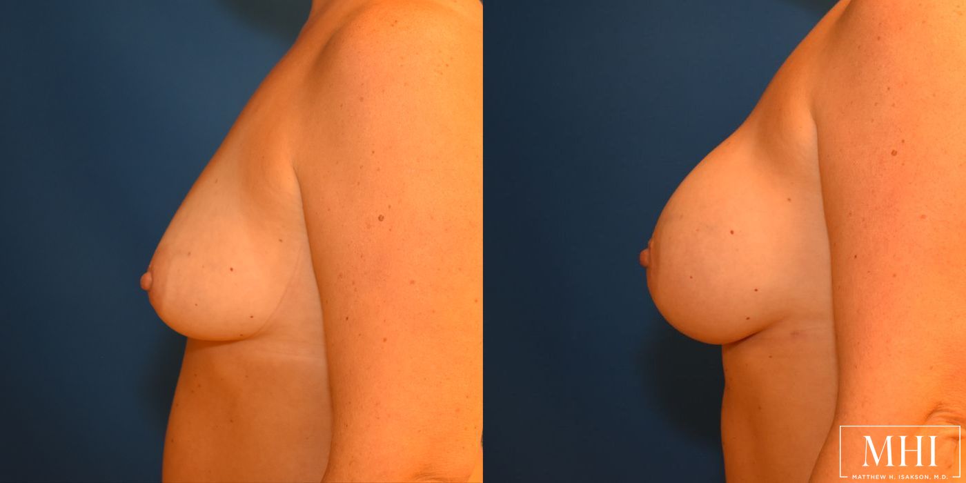 Breast Augmentation - Thumbnail 3