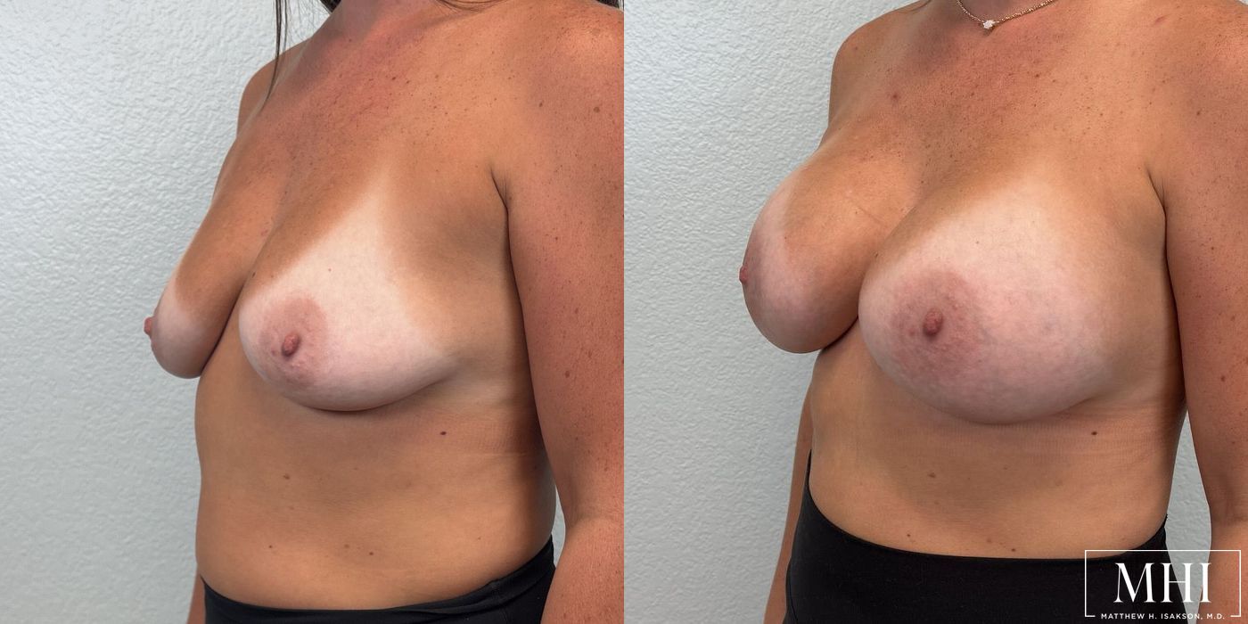 Breast Augmentation - Thumbnail 2