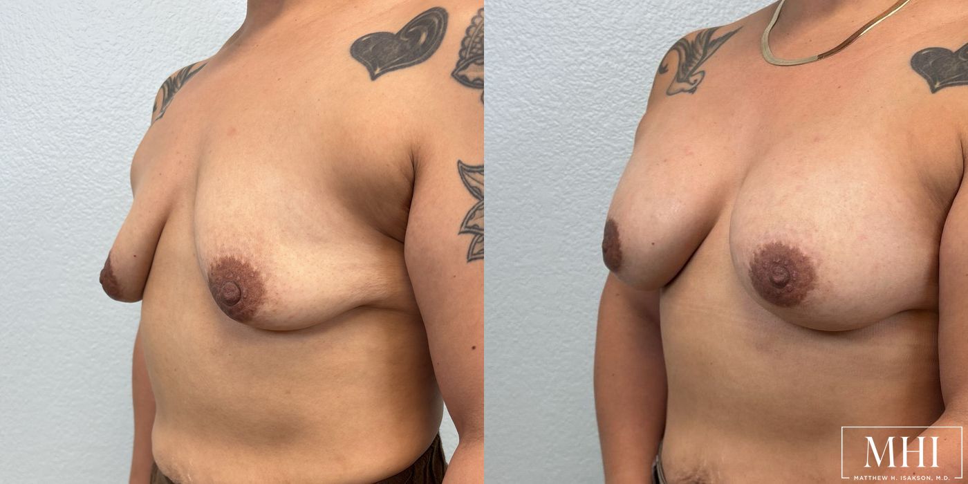 Breast Augmentation - Thumbnail 2