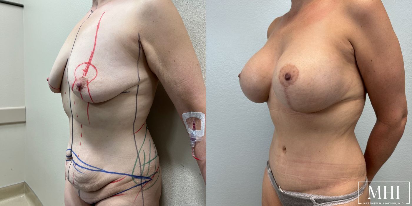 Breast Augmentation - Case 12112