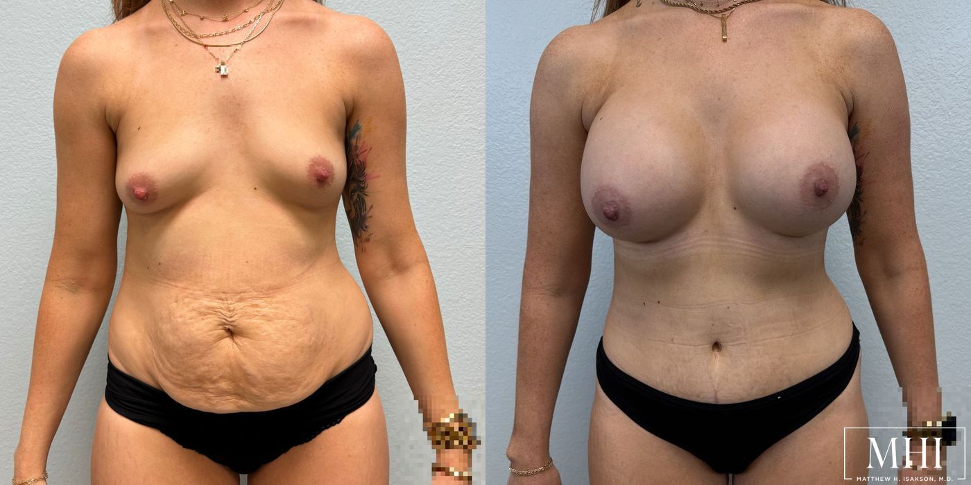 Breast Augmentation - Thumbnail 2