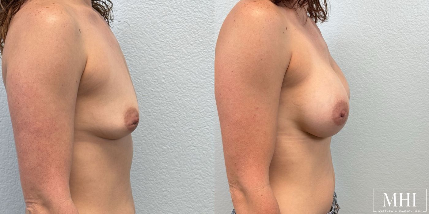 Breast Augmentation - Thumbnail 5