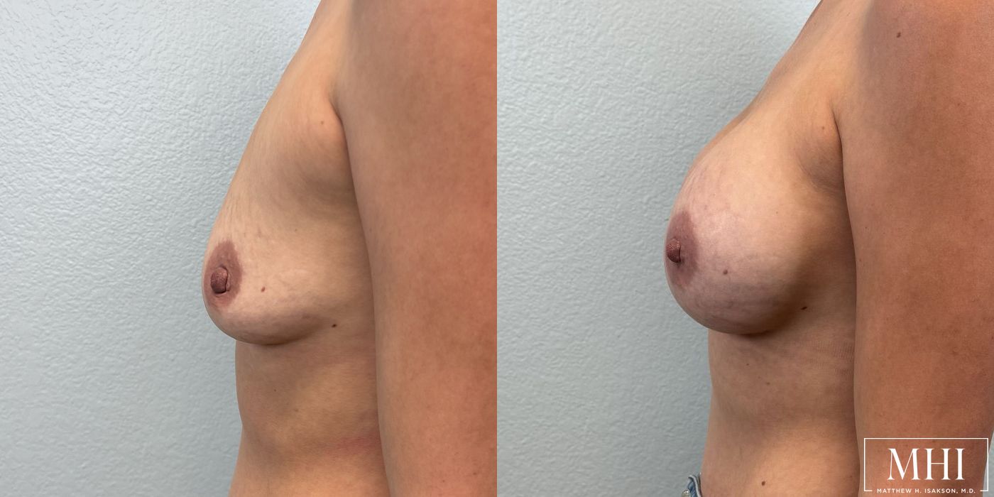 Breast Augmentation - Thumbnail 5
