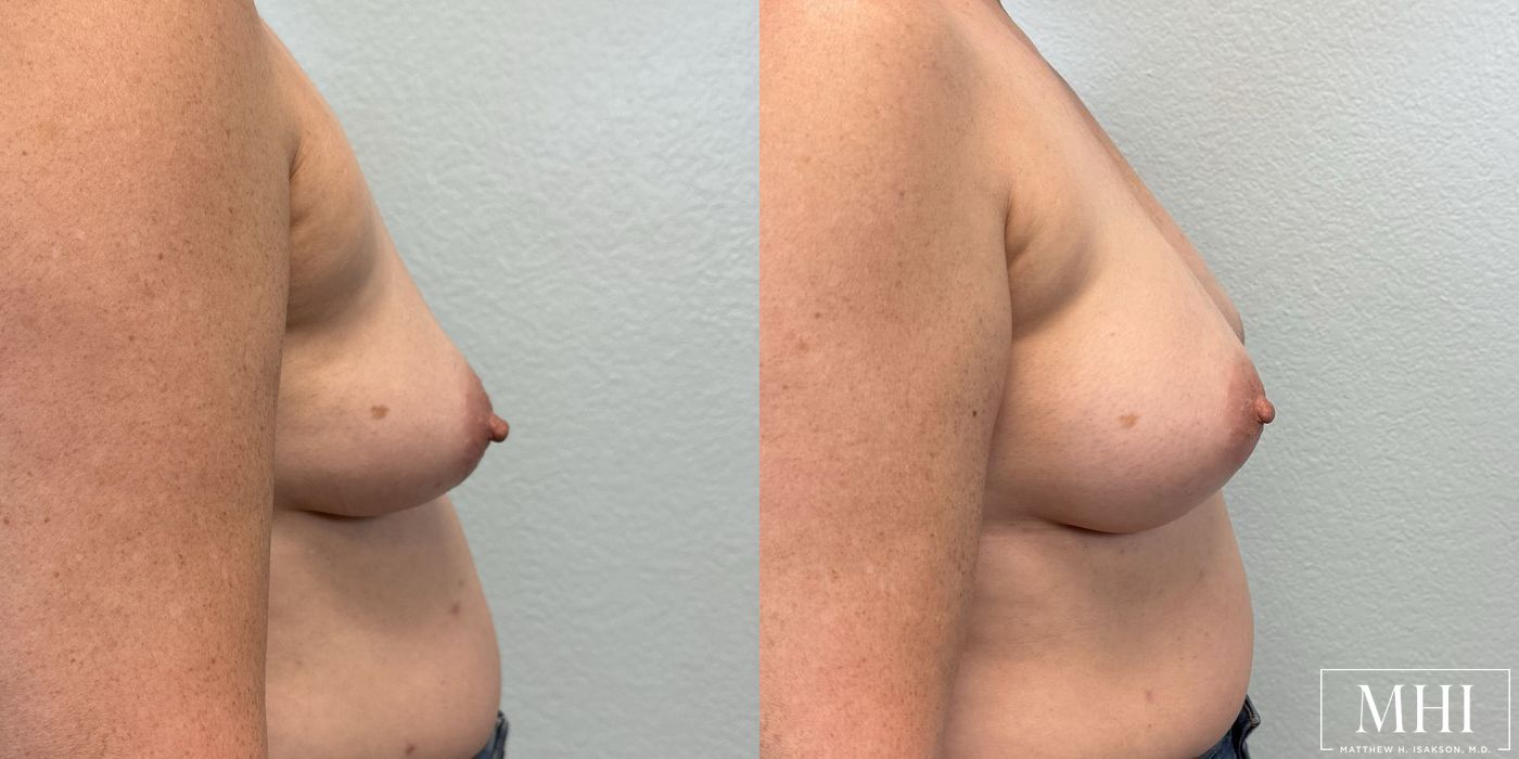 Breast Augmentation - Thumbnail 2