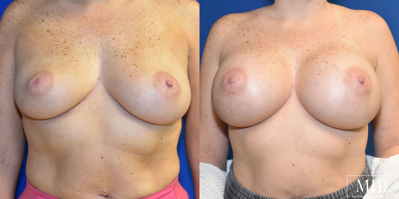 Breast Augmentation - Case 12119