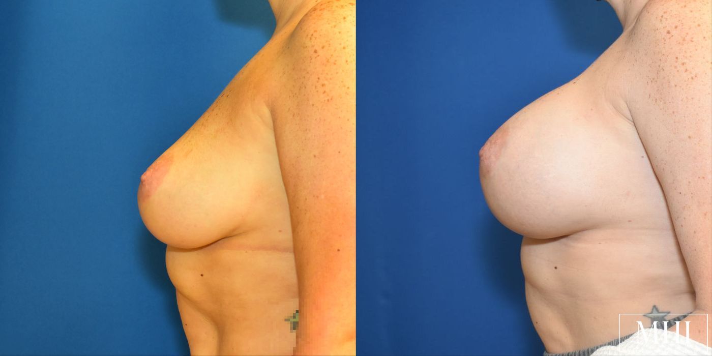 Breast Augmentation - Thumbnail 2