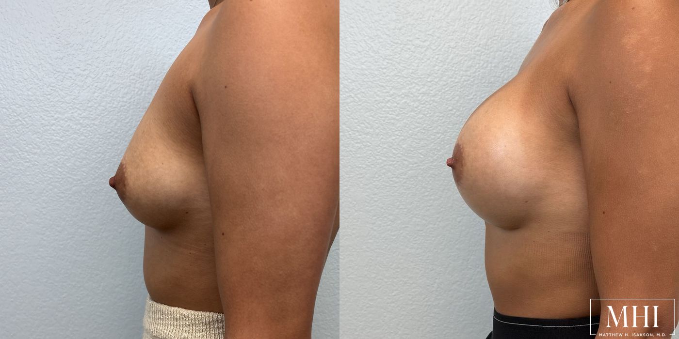 Breast Augmentation - Thumbnail 3