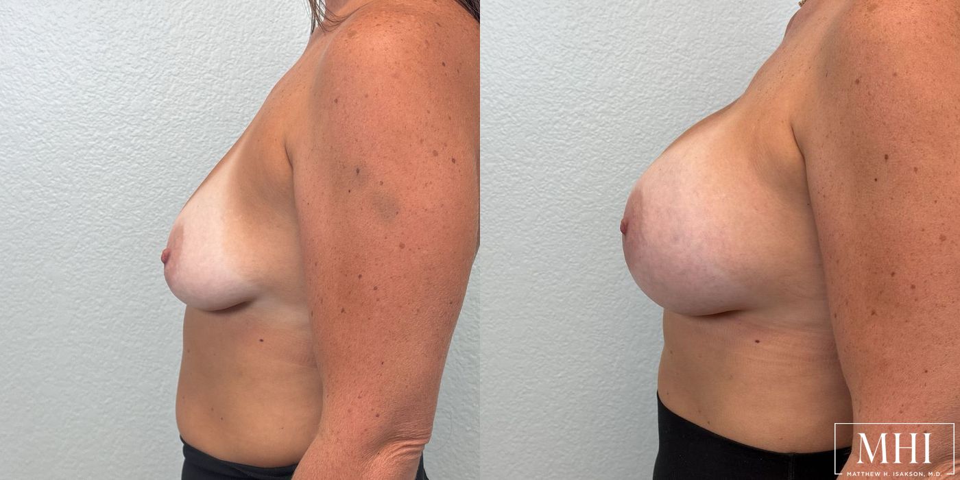 Breast Augmentation - Thumbnail 3