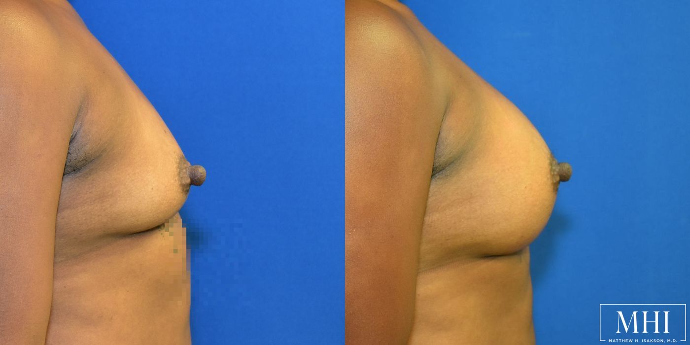 Breast Augmentation - Case 12439