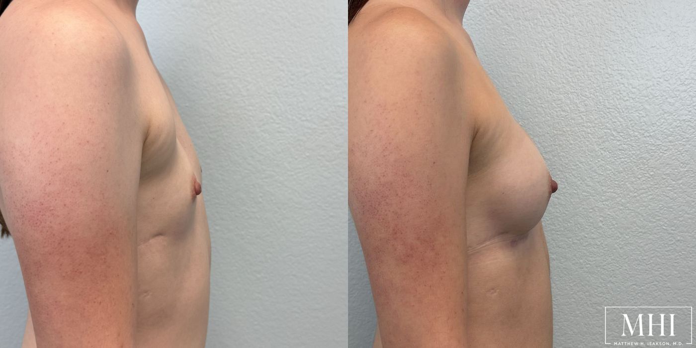 Breast Augmentation - Case 12431