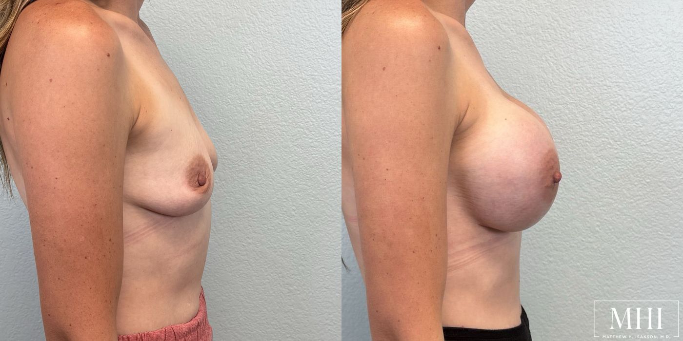 Breast Augmentation - Thumbnail 5