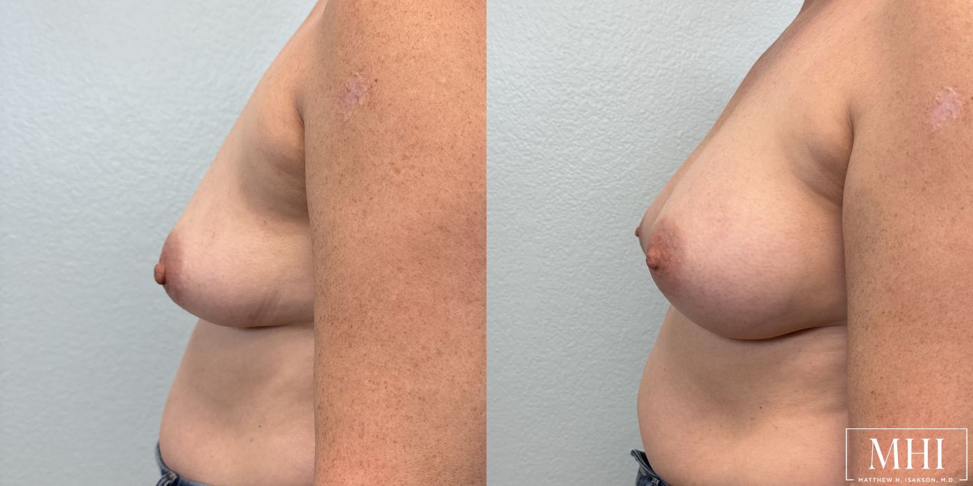 Breast Augmentation - Thumbnail 5