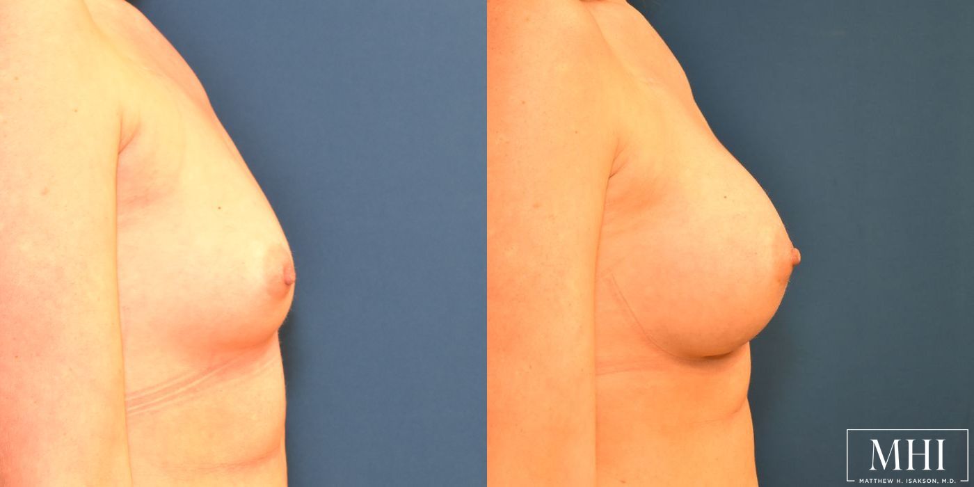 Breast Augmentation - Thumbnail 5