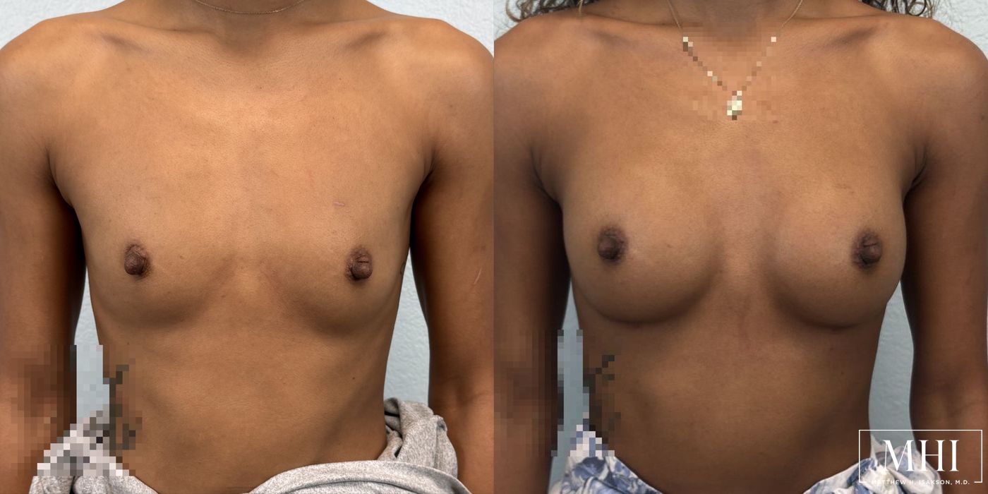 Breast Augmentation - Case 12433
