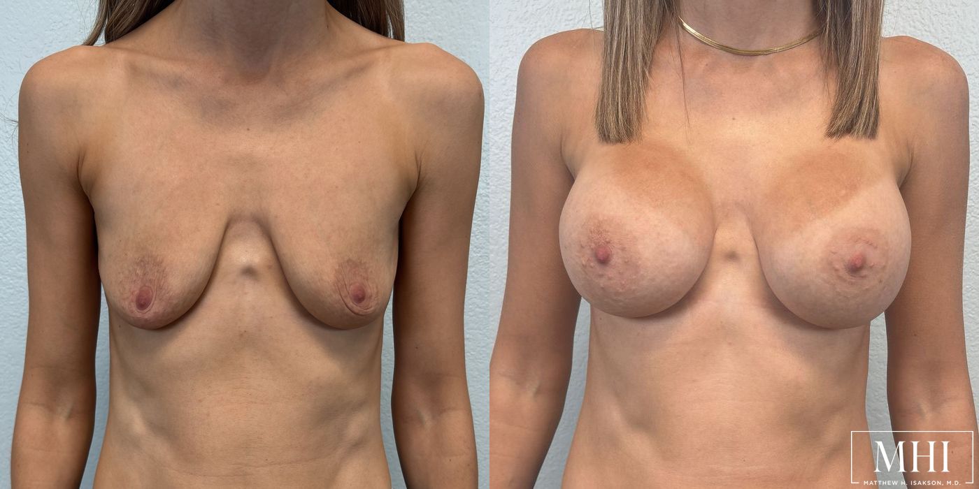 Breast Augmentation - Case 12113