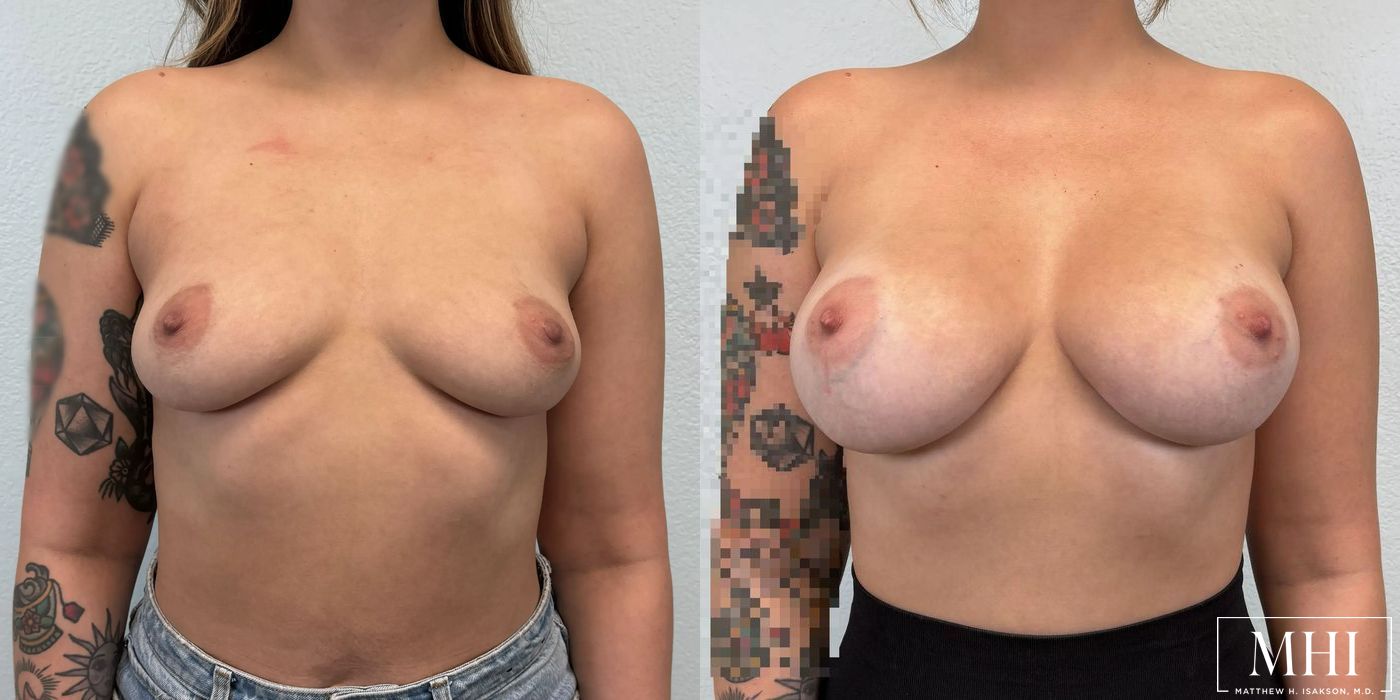 Breast Augmentation - Case 12123