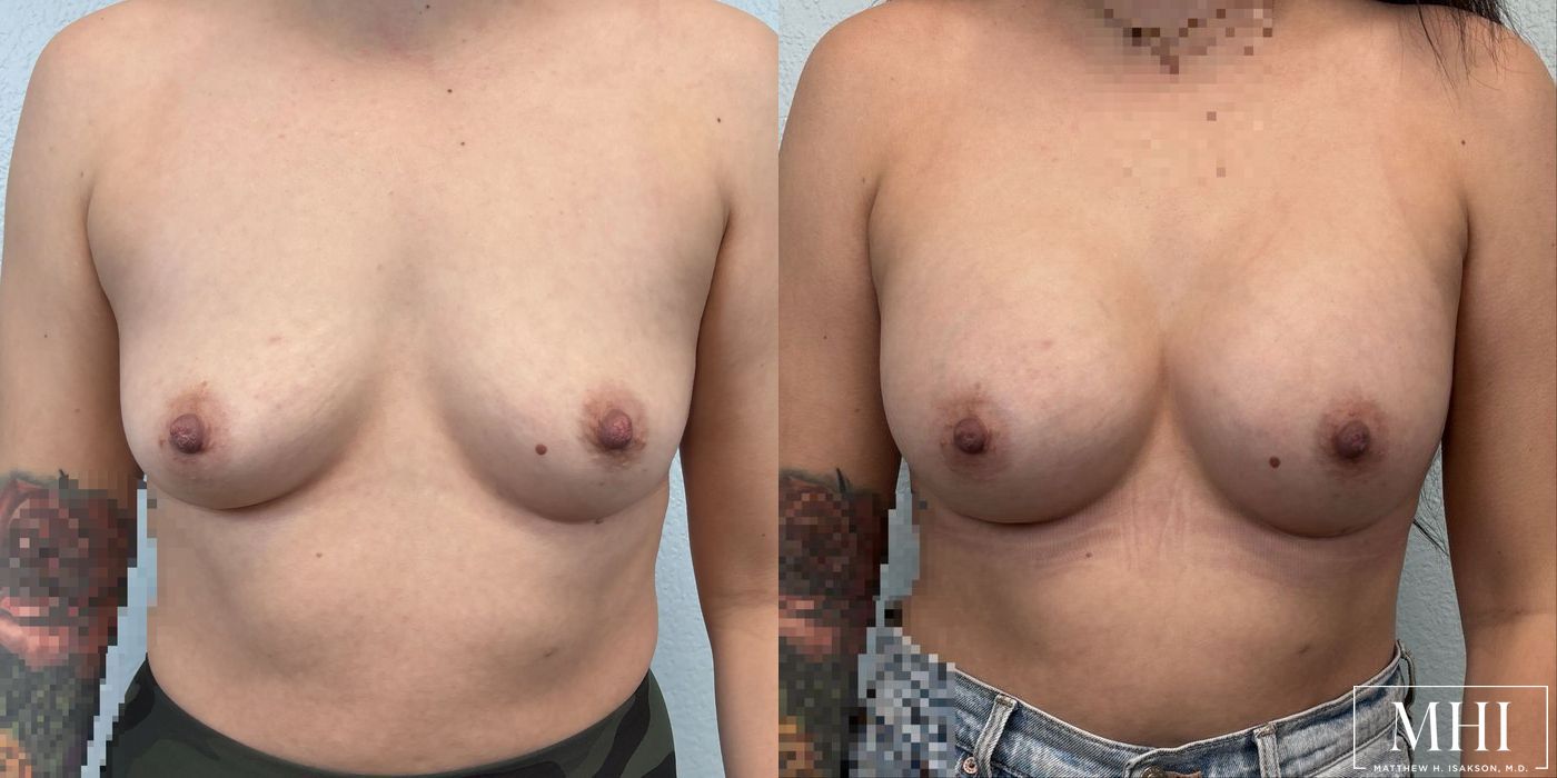 Breast Augmentation - Case 12434