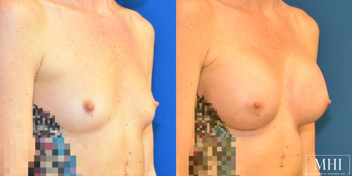 Breast Augmentation - Thumbnail 2