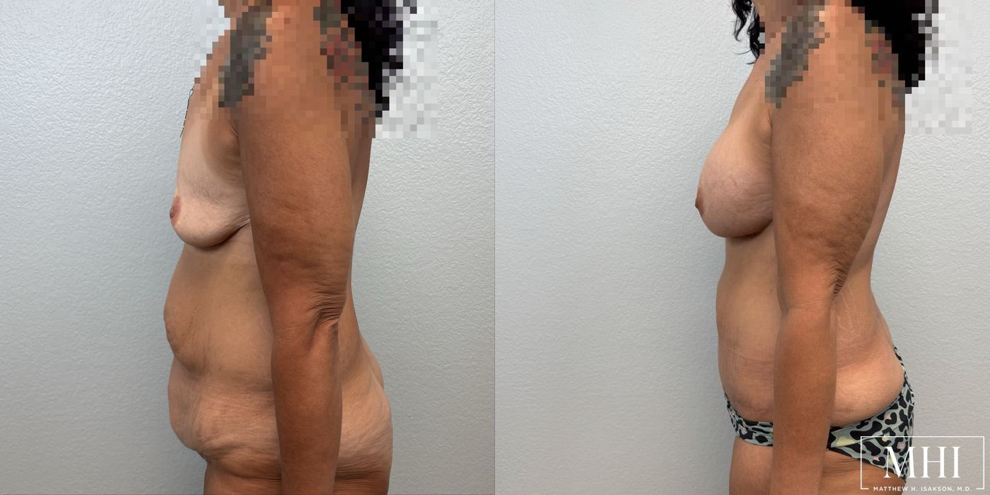 Breast Augmentation - Thumbnail 5