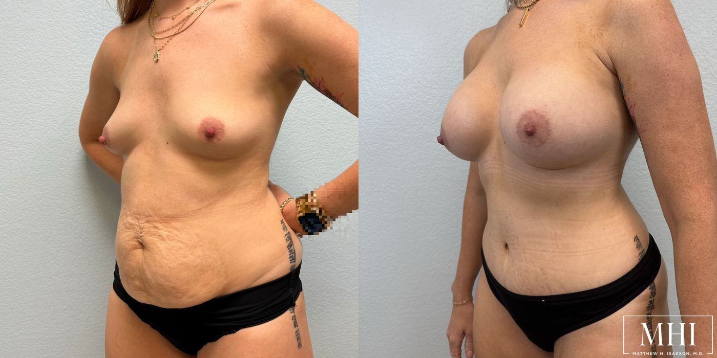 Breast Augmentation - Case 12090