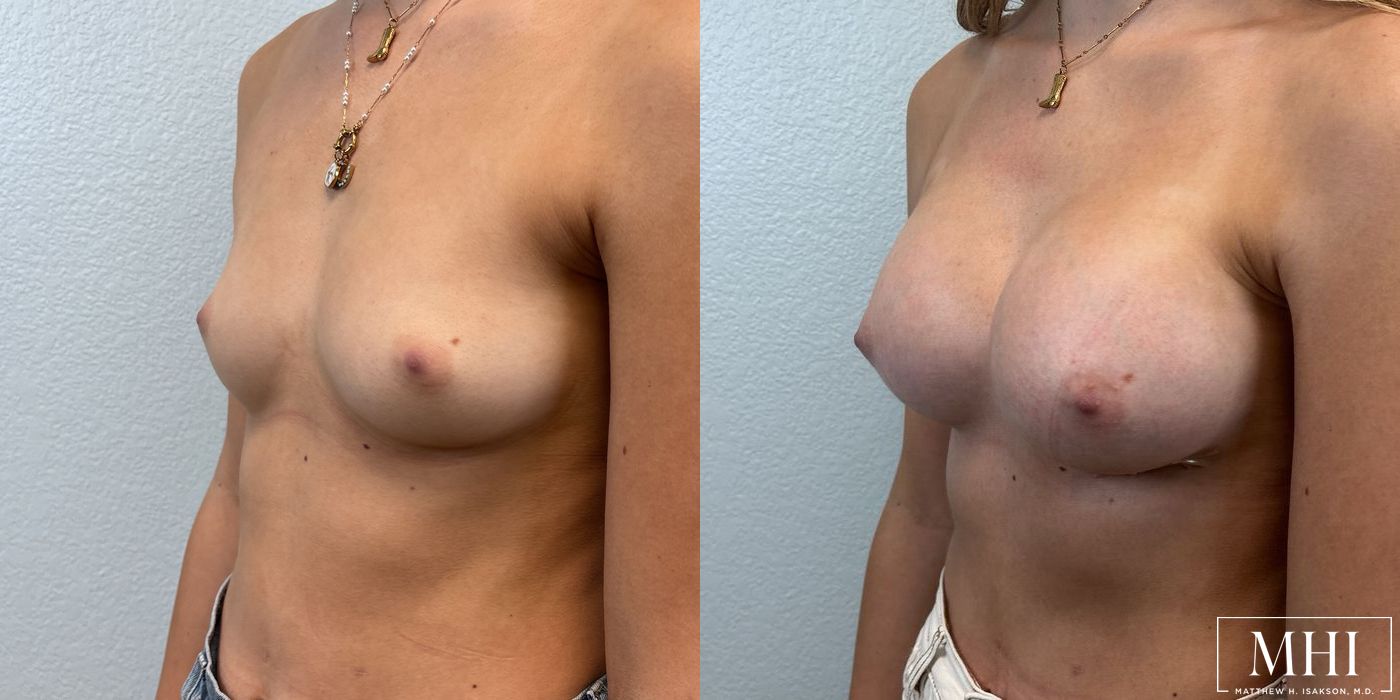 Breast Augmentation - Thumbnail 4