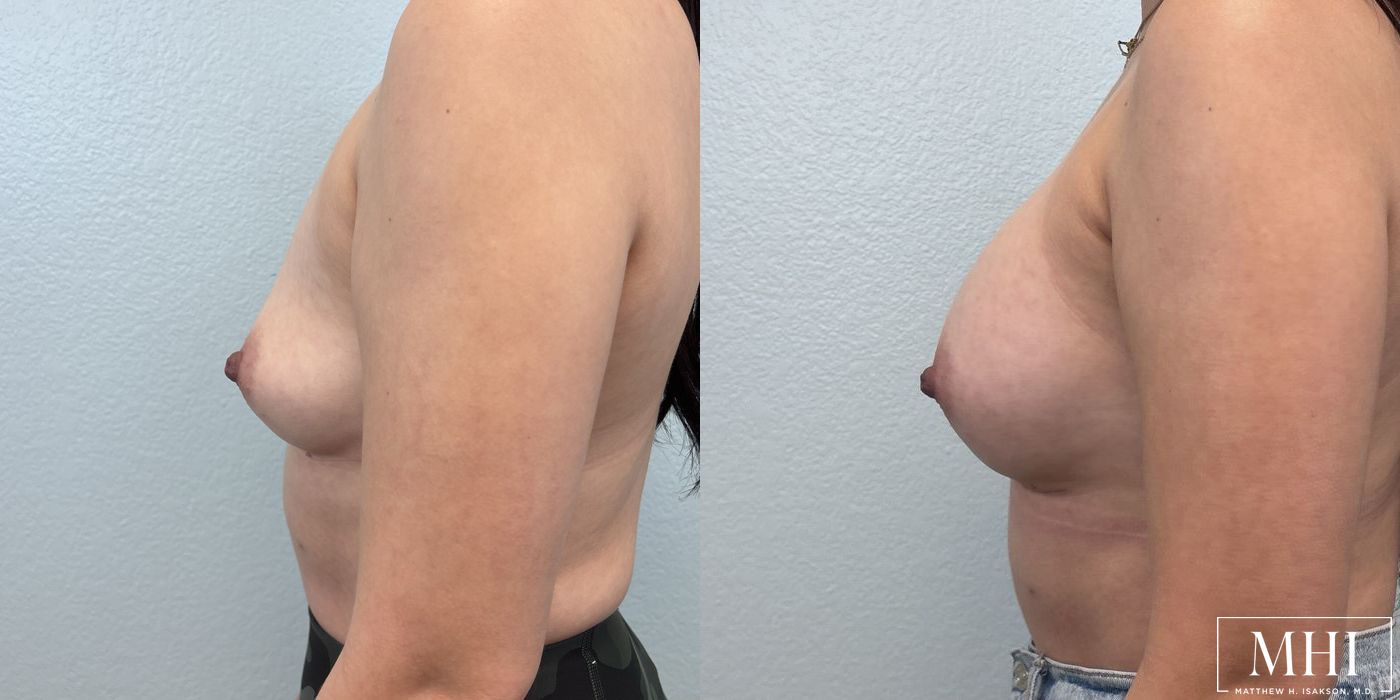 Breast Augmentation - Thumbnail 3