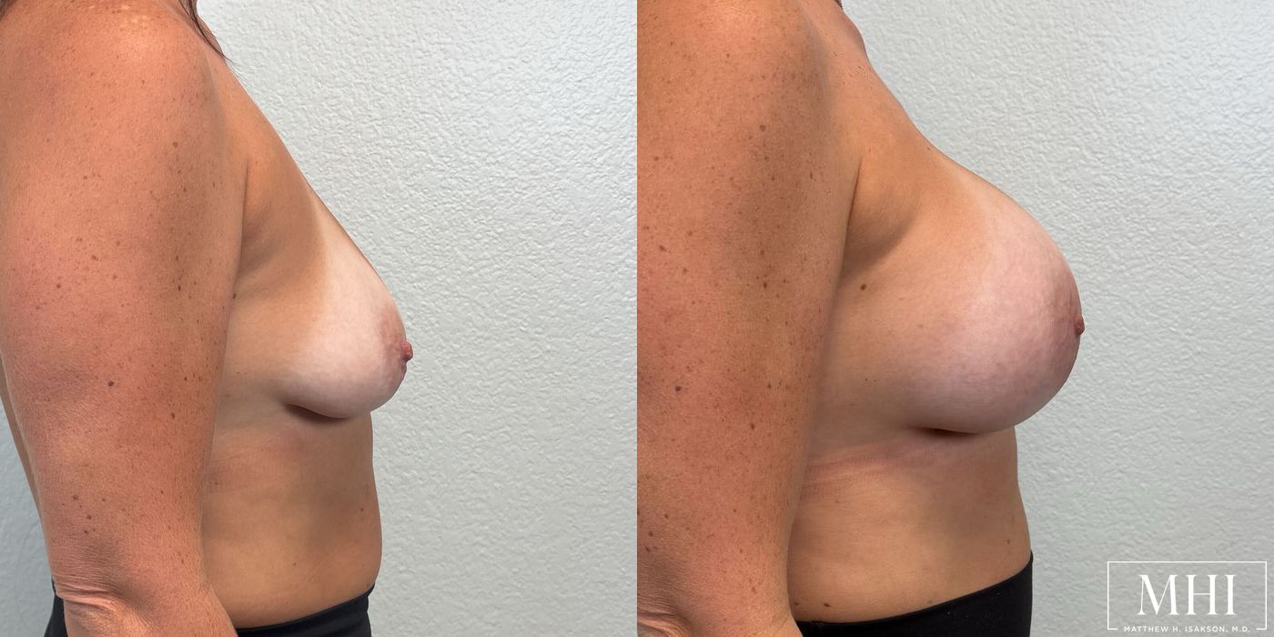 Breast Augmentation - Thumbnail 5
