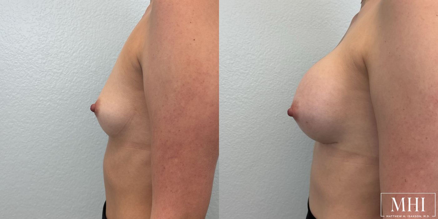 Breast Augmentation - Thumbnail 3