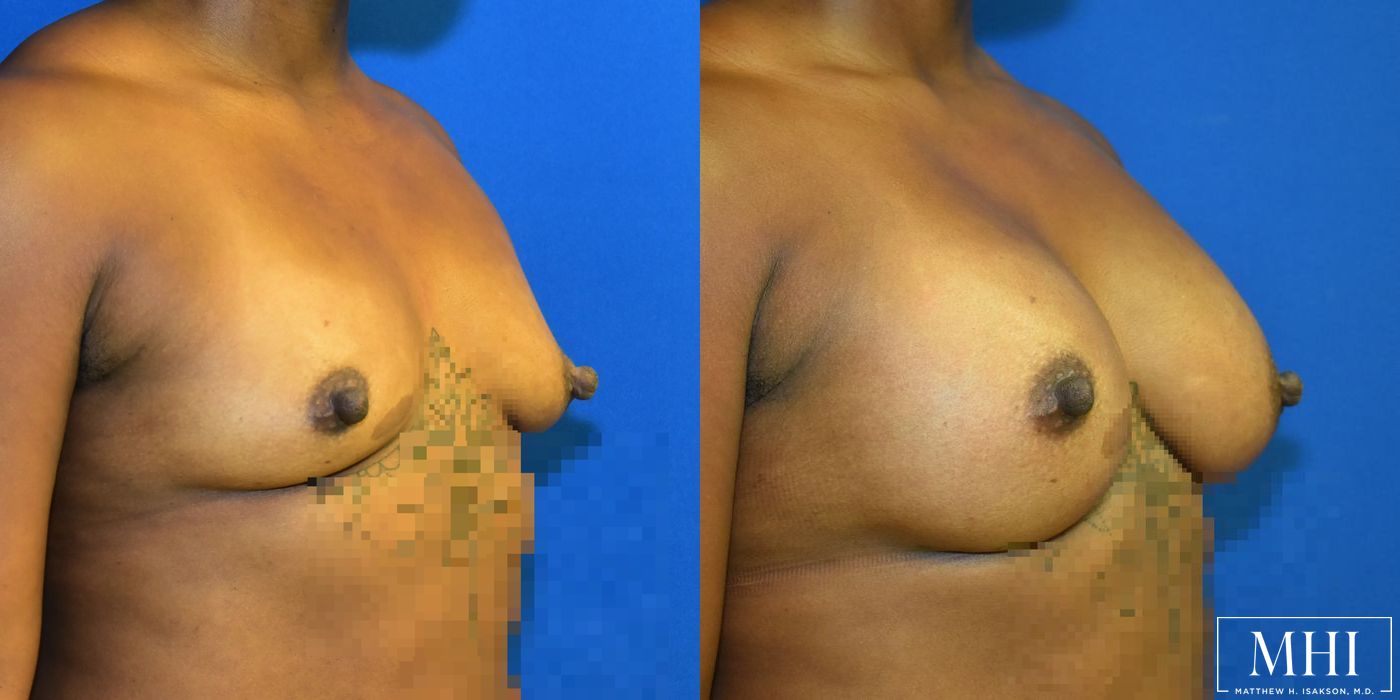 Breast Augmentation - Thumbnail 2