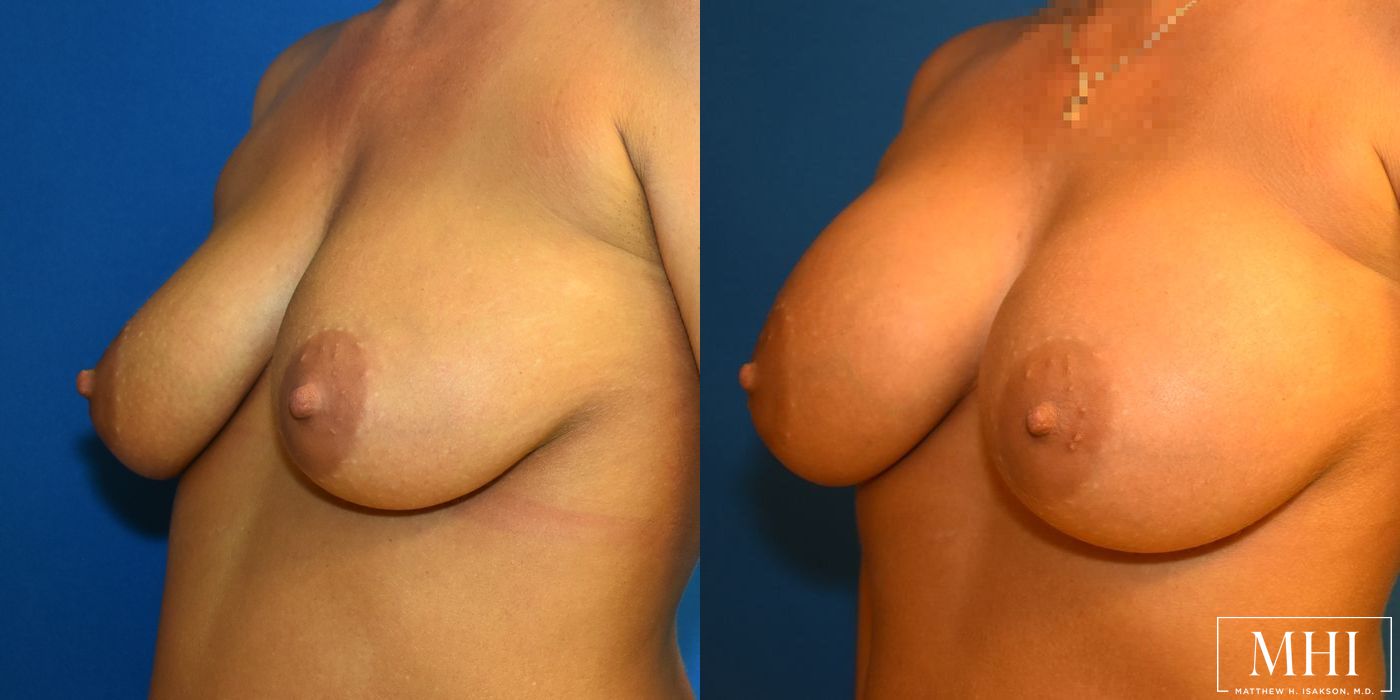 Breast Augmentation - Thumbnail 2
