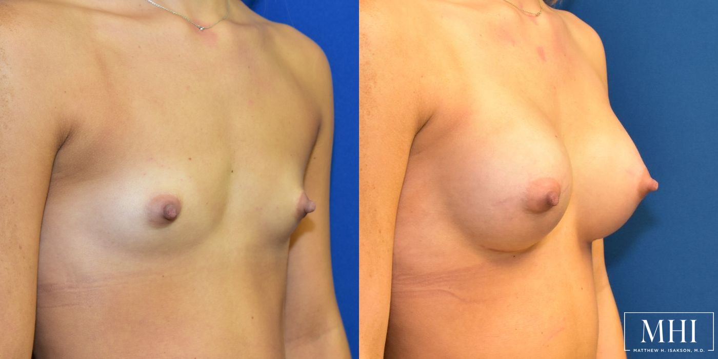 Breast Augmentation - Thumbnail 4