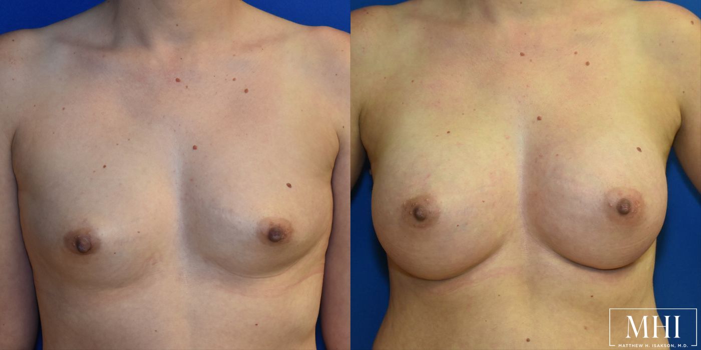 Breast Augmentation - Case 12117