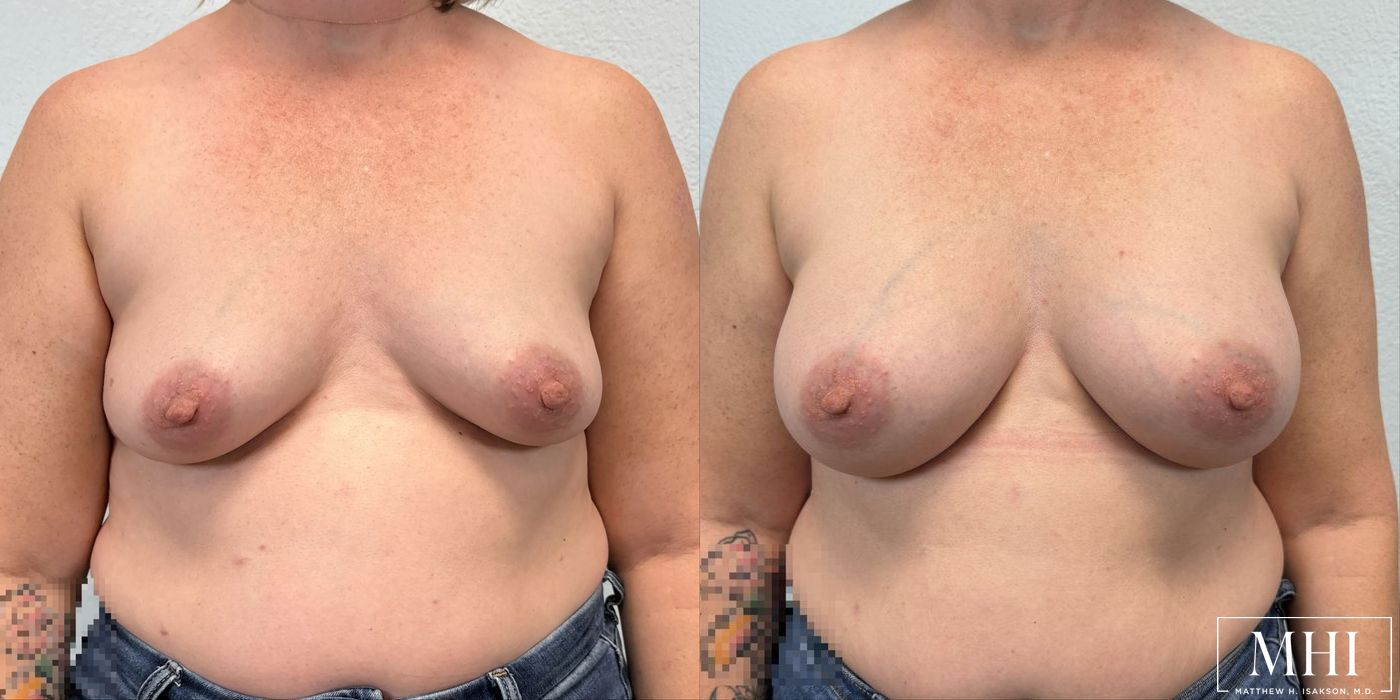 Breast Augmentation - Thumbnail 3