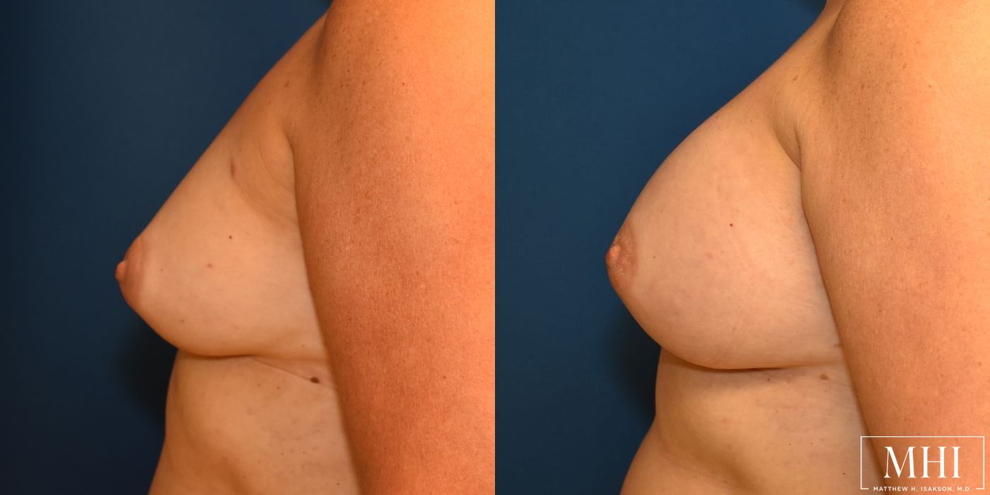 Breast Augmentation - Case 12436
