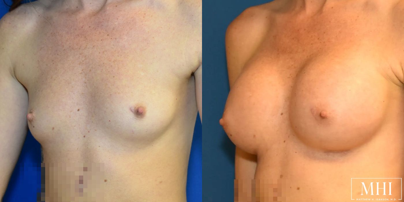 Breast Augmentation - Thumbnail 3