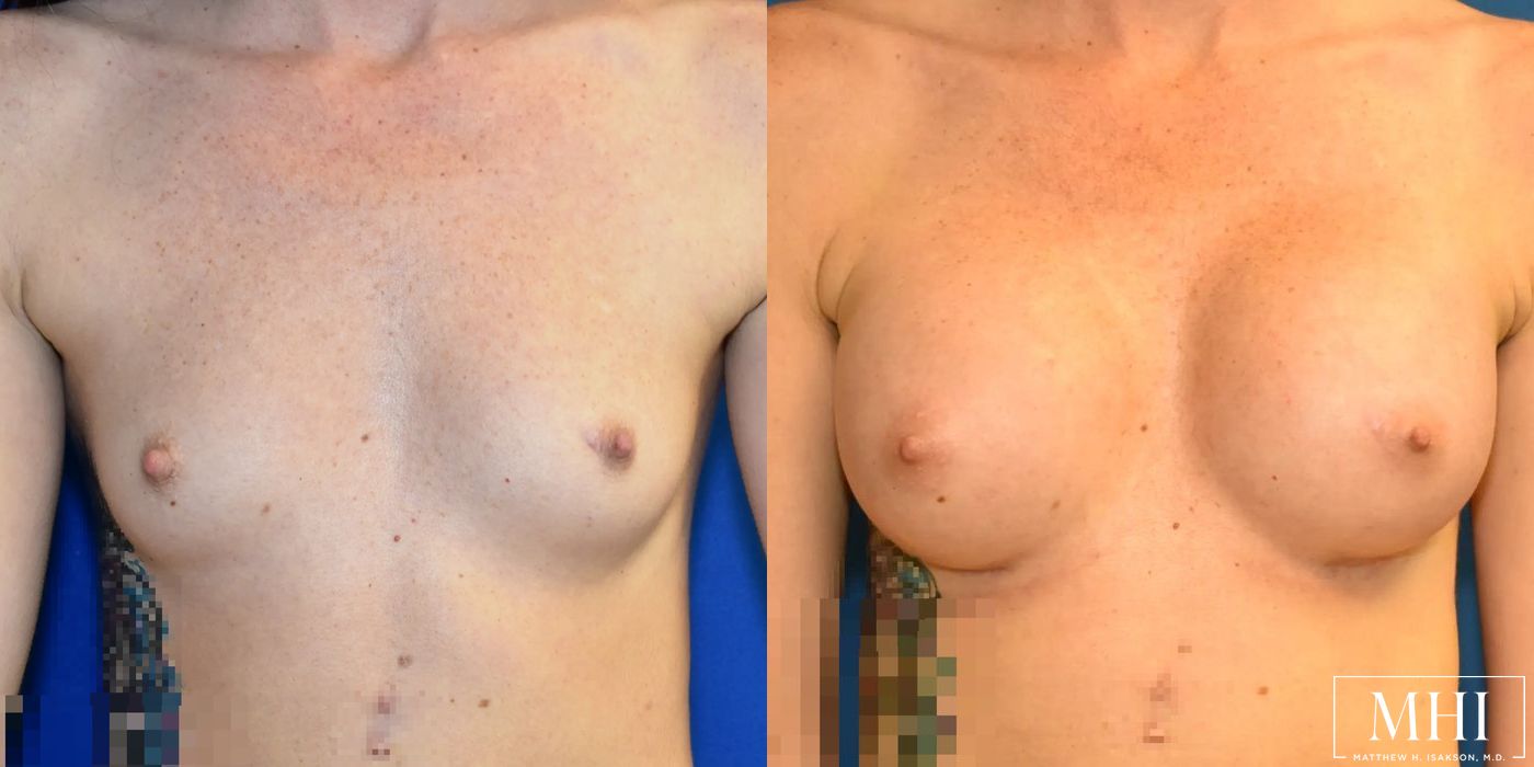 Breast Augmentation - Case 12116