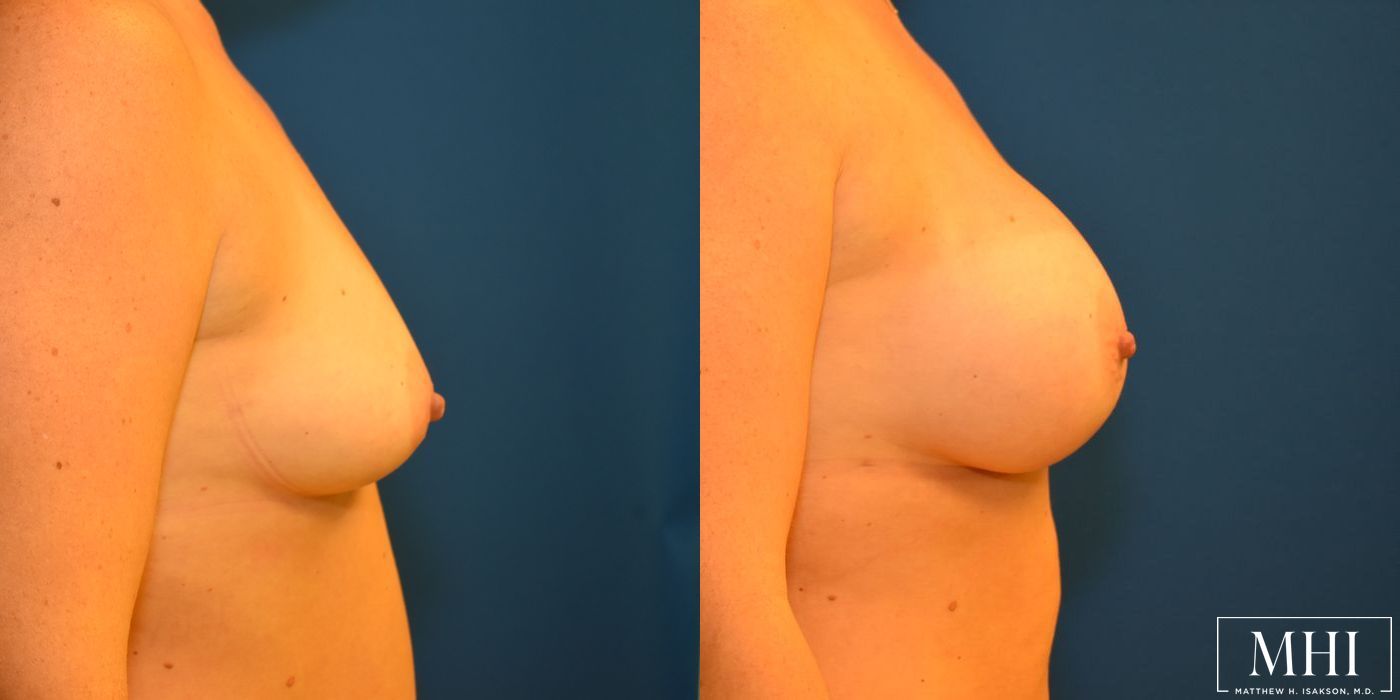 Breast Augmentation - Thumbnail 5