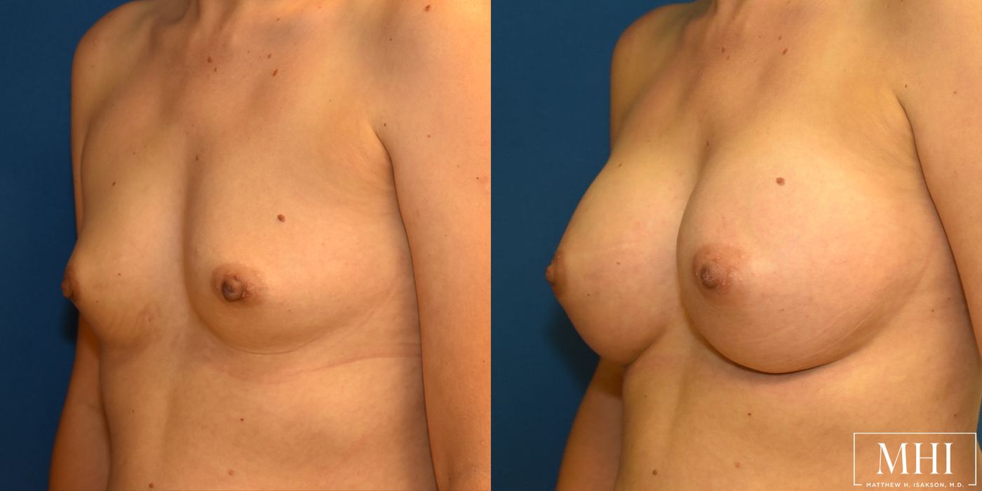 Breast Augmentation - Thumbnail 4