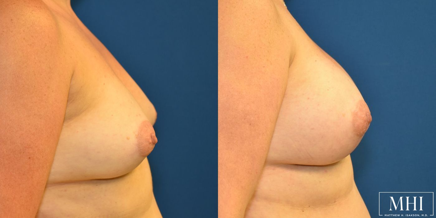 Breast Augmentation - Thumbnail 5