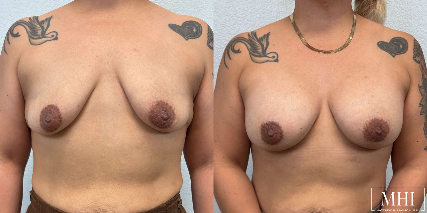 Breast Augmentation - Thumbnail 3