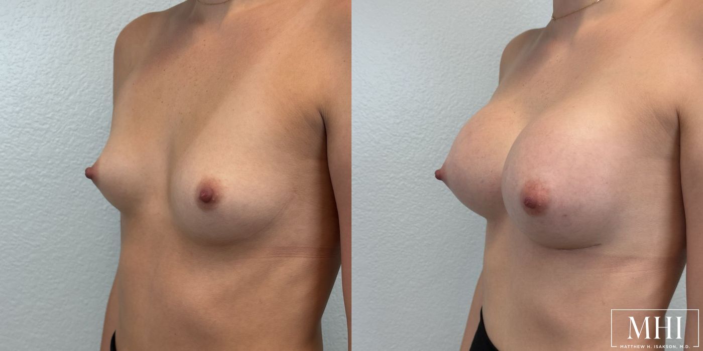 Breast Augmentation - Thumbnail 2