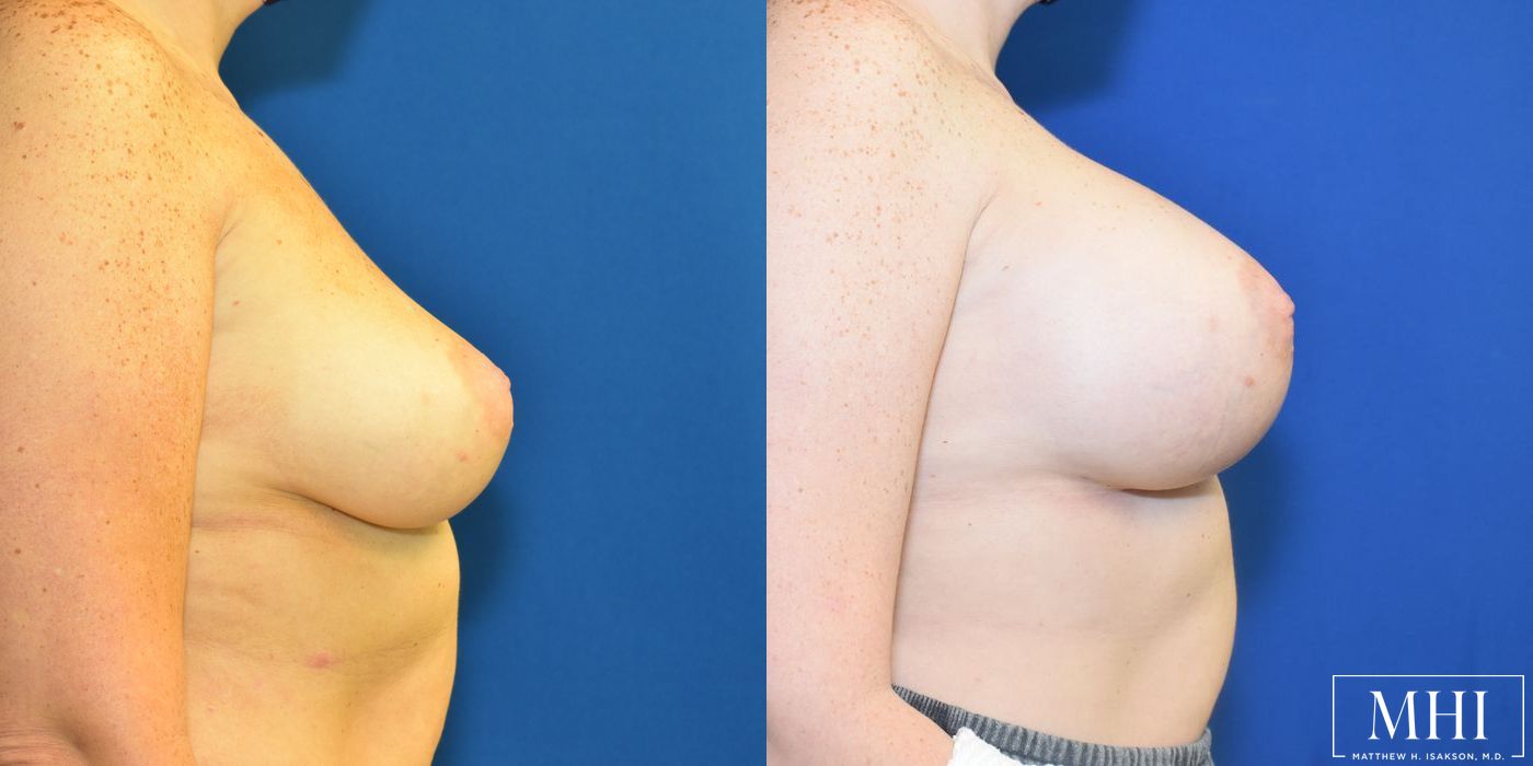 Breast Augmentation - Thumbnail 3
