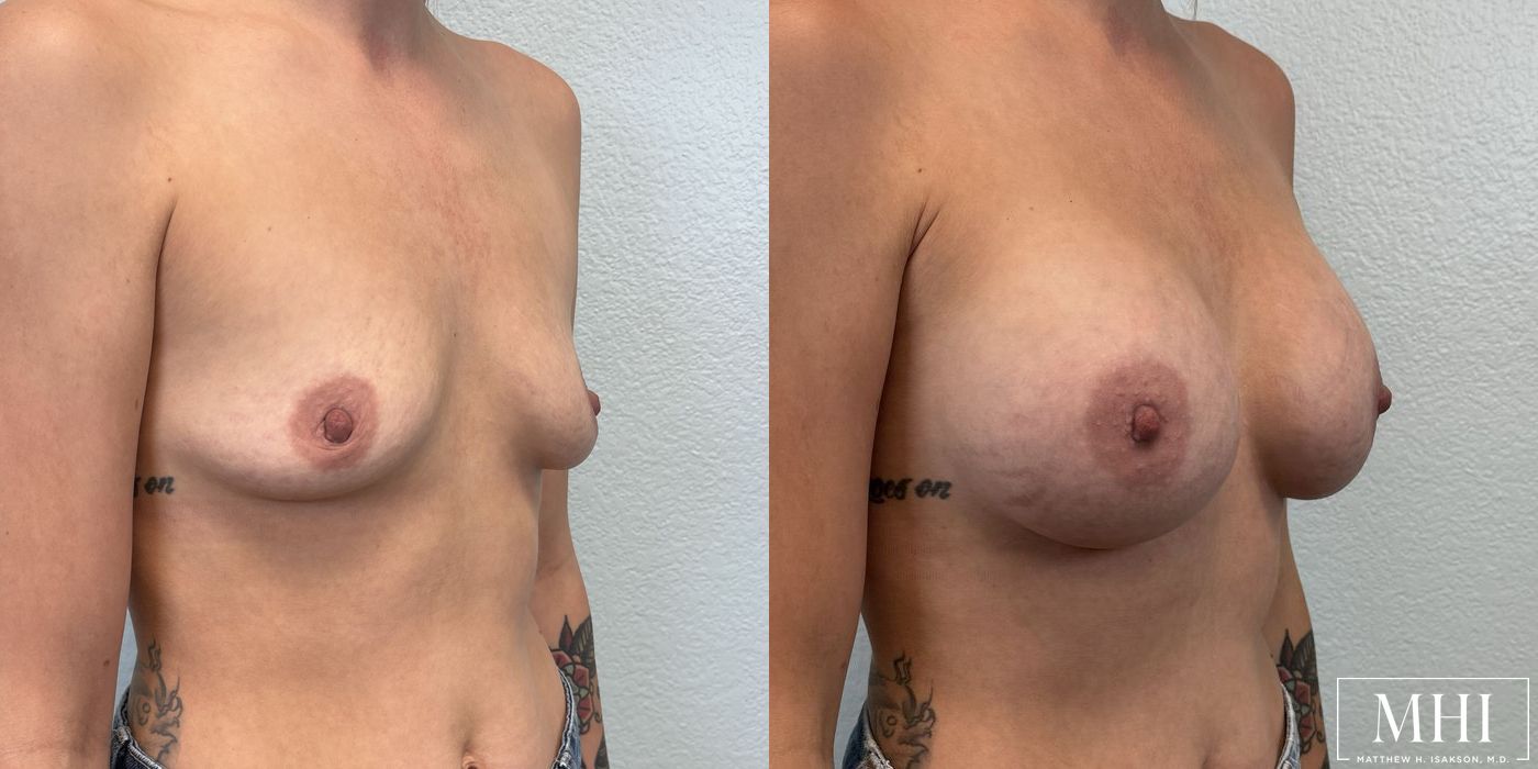 Breast Augmentation - Thumbnail 2