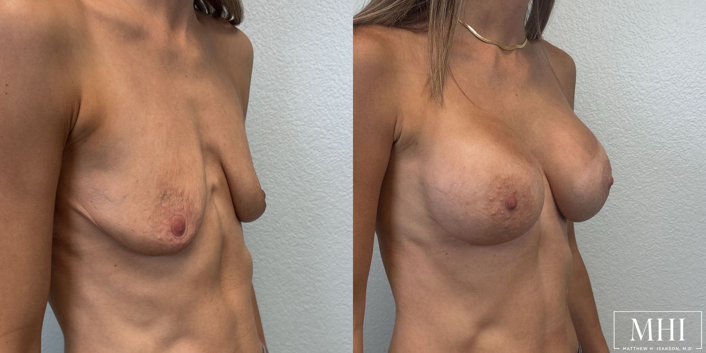 Breast Augmentation - Thumbnail 2