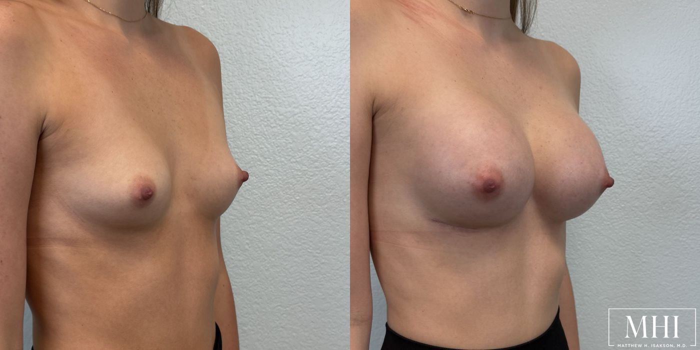 Breast Augmentation - Thumbnail 4