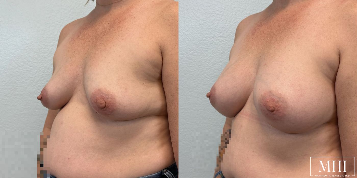 Breast Augmentation - Thumbnail 4